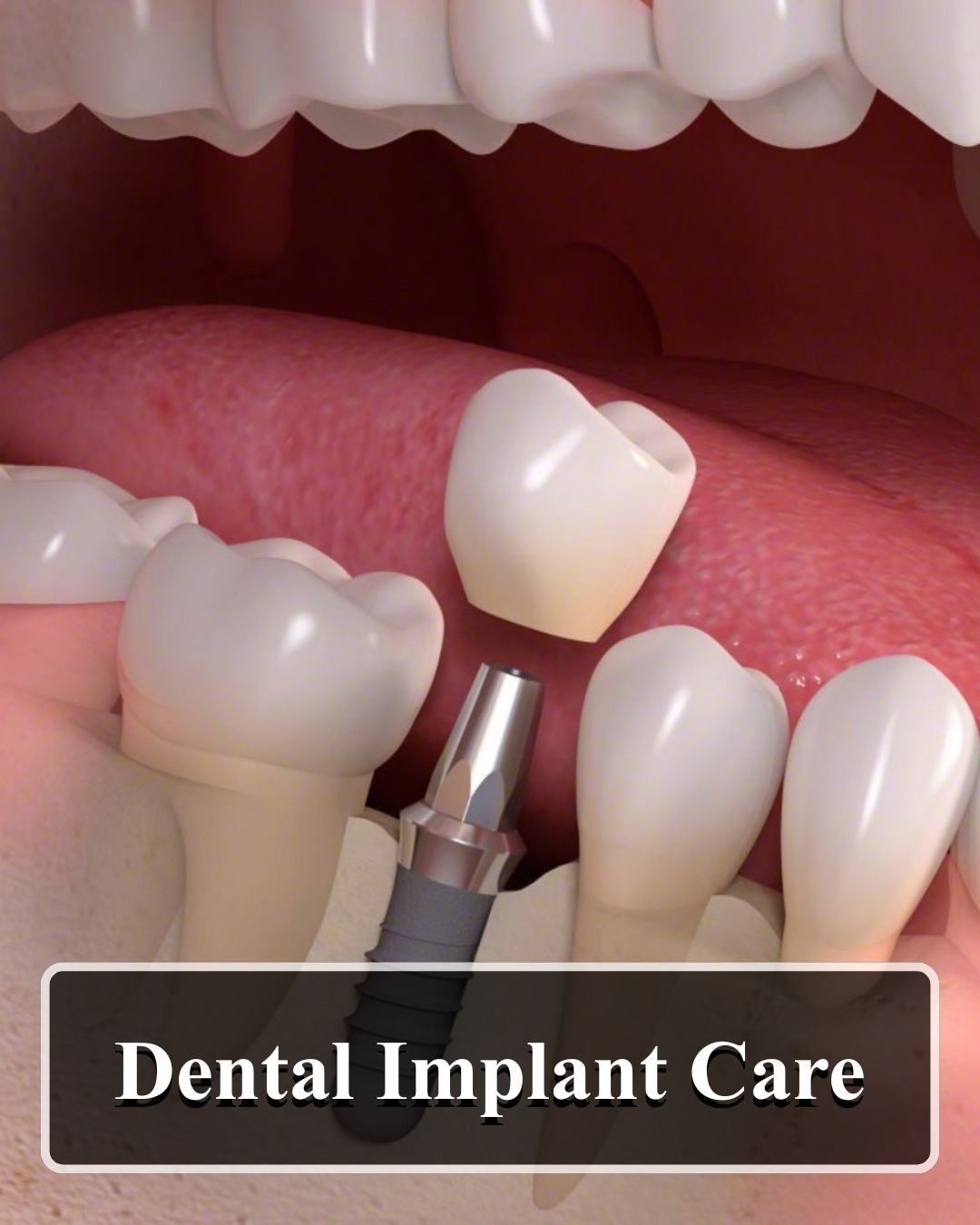 dental-implant-care