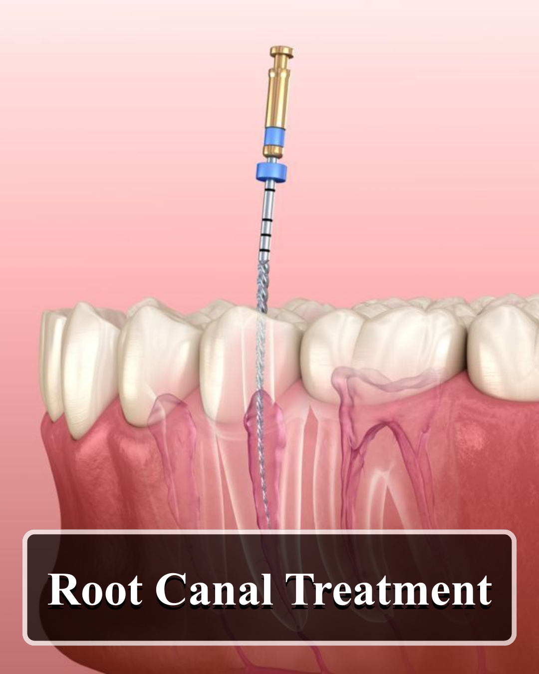 root-canal-treatment